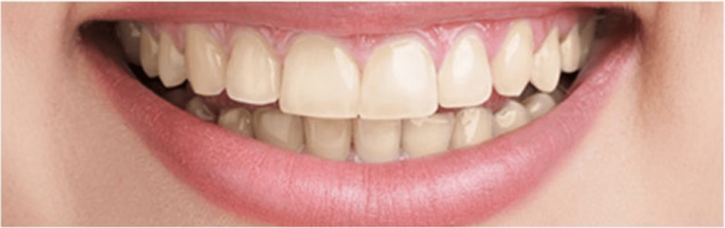 Teeth Whitening in Bayswater, London - Close up white smile front on before
