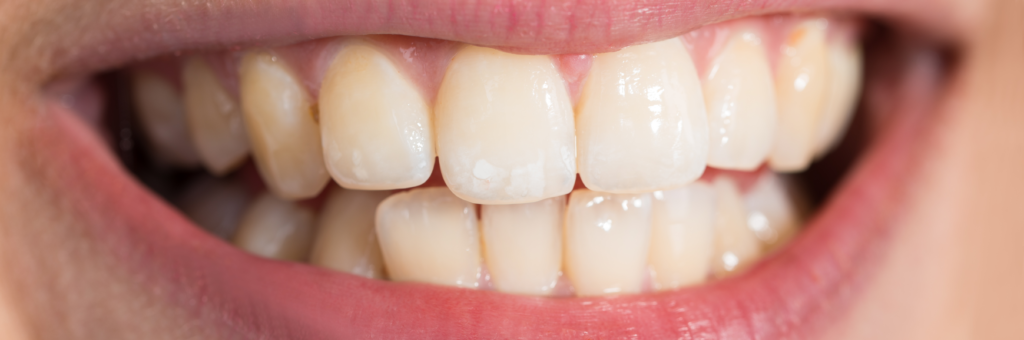 Close up white smile before