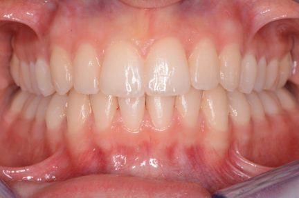 Invisalign in Bayswater after 2