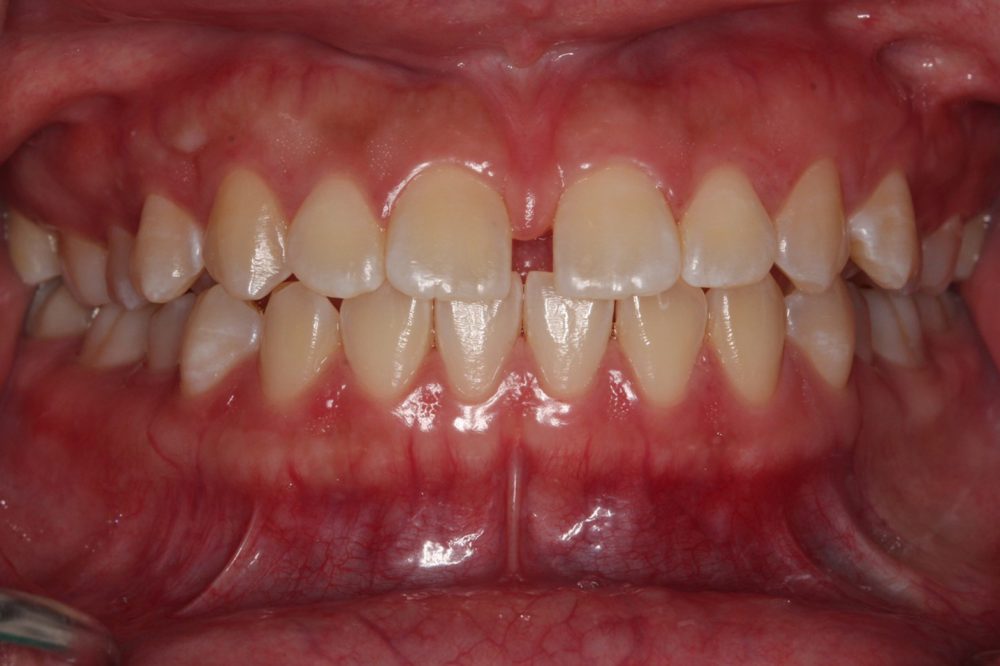 Invisalign in Bayswater before 1