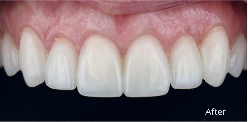 Composite bonding top teeth after