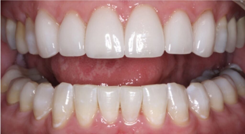 Composite bonding closeup after