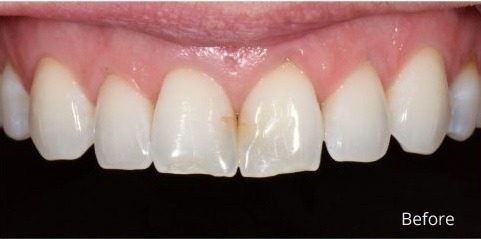 Composite bonding top teeth before