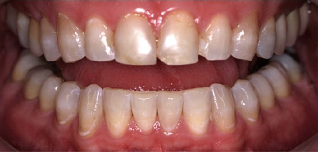veneers in bayswater -Composite bonding closeup before