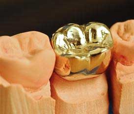 Dental Crowns Bayswater - Gold crown