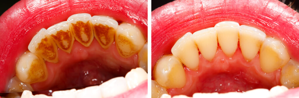 Dental Hygiene In Bayswater - Airflow Stain Removal before and after