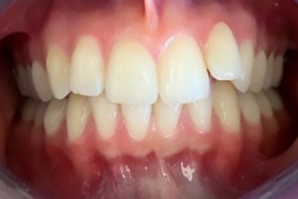 invisalign in london