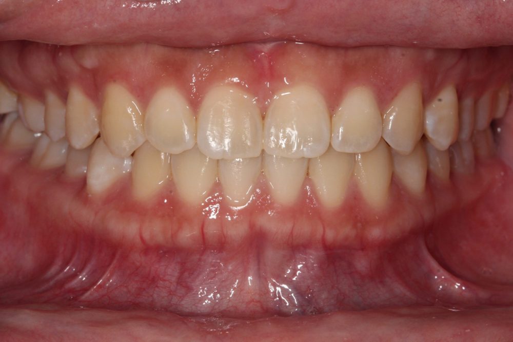 invisalign in london