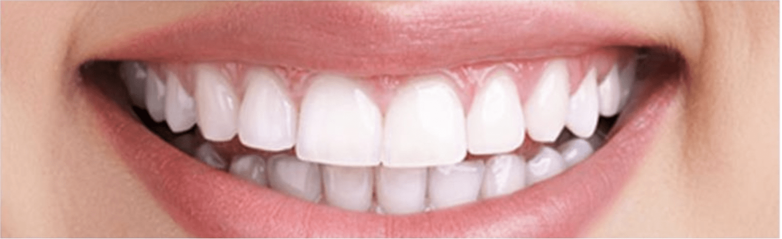 teeth whitening in london