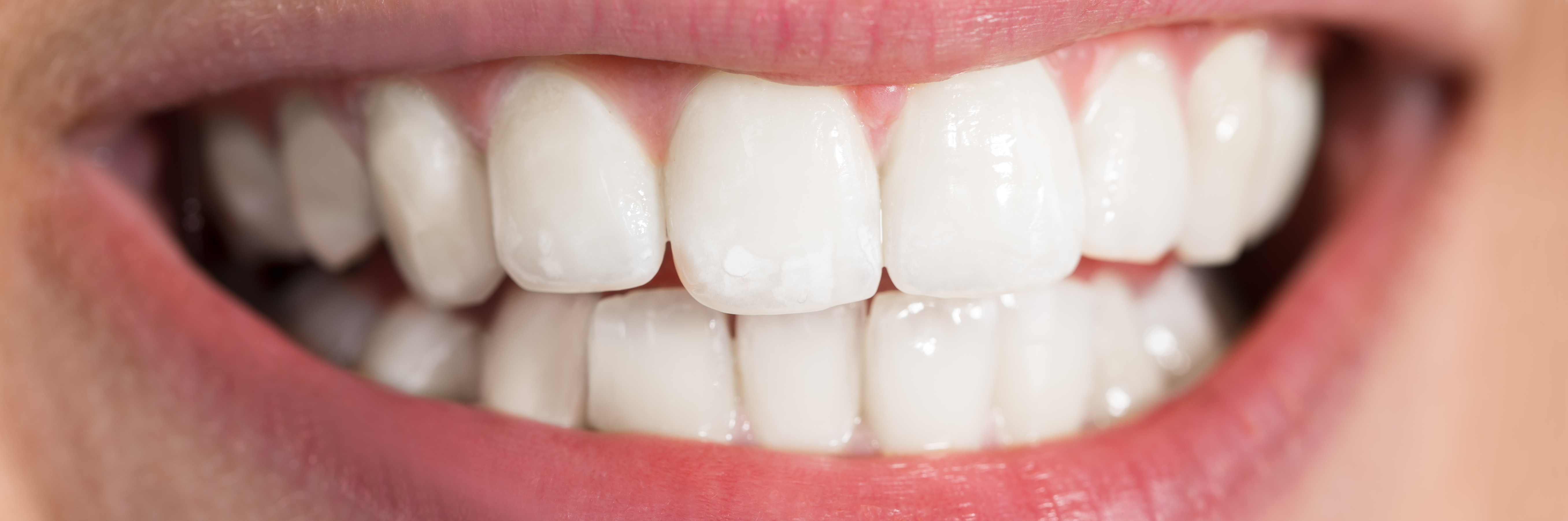 teeth whitening in london