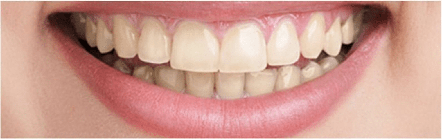 teeth whitening in london